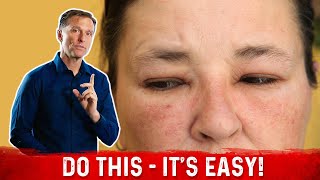 How to Fix the Swollen Face Facial Puffiness and Puffy Eyes – DrBerg [upl. by Sulamith]