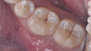 Direct composite restoration with selective caries removal [upl. by Inatirb]