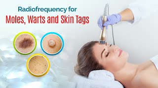 Is Radio Frequency Surgery safe for removing Moles Warts Skin Tags [upl. by Souza]