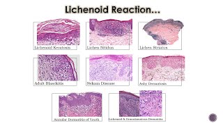 8 Lichenoid Dermatoses 2 [upl. by Hilario]