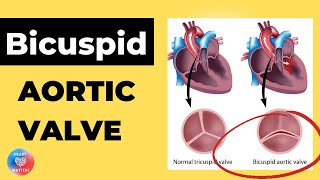 Bicuspid Aortic Heart Valve [upl. by Aridatha]