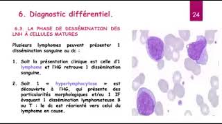 Hemato 13Leucémie lymphoide chronique LLC Dr Abbadi [upl. by Tasiana872]