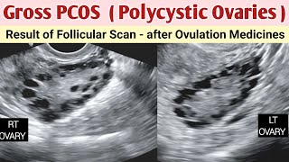 Polycystic Ovaries  Gross Grade 3  PCOS  Ultrasound after Ovulation Medication [upl. by Inattyrb]