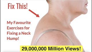 How to Fix a Neck Hump at Home FAST  With FREE Exercise Sheet [upl. by Volkan]