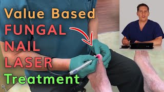 Value Based Fungal Nail Laser Treatment by Dr Michael Horwitz [upl. by Ativla]