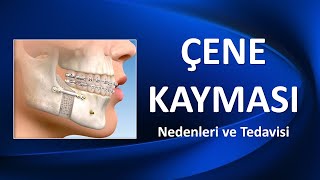 Ã‡ENE KAYMASI Nedenleri ve Tedavisi [upl. by Nerrad]