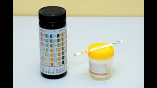 Dipstick Urinalysis Analysis [upl. by Elrebma]