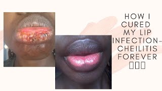 How I cured lip infection  Cheilitis [upl. by Lasala]