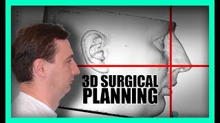 3D Virtual Surgical Planning ORTHOGNATHIC [upl. by Ycram849]