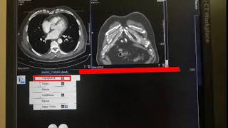 ANGIOTOMOGRAFIA DE AORTA TORÁCICA  DIEGO CESAR [upl. by Nodlew]