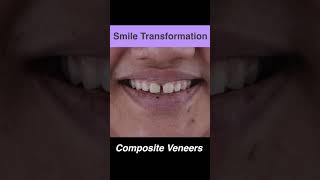 Teeth Gap Closure In One Visit Without Braces  By DrPraneeth Kumar [upl. by Biondo]