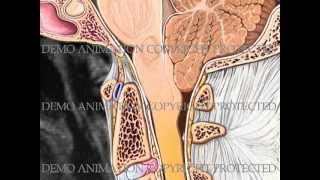 Understanding Chiari malformation [upl. by Westbrook]