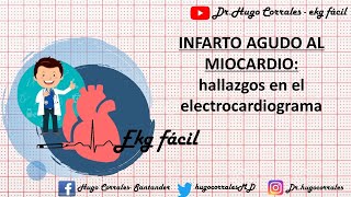 INFARTO AGUDO DE MIOCARDIO Hallazgos electrocardiográficos [upl. by Ahsemrac]