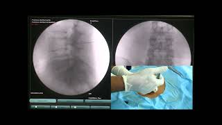 Transforaminal Epidural Under Ultrasound  Transforaminal Epidural Injection Technique [upl. by Thomasin]