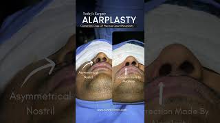 Asymmetrical Nose Correction  Alarplasty by Dr Adarsh Tripathi [upl. by Keung]