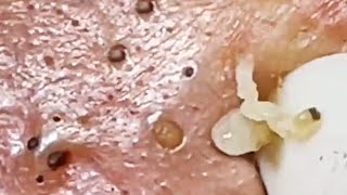 Deep blackhead extraction Cystic acne amp pimple popping 77 [upl. by Cox]