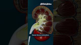 Renal Stone Animation  Kidney Stone Shortsb kidney motivation kidneydisease viralvideo shorts [upl. by Nimra]