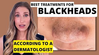 Blackheads Dermatologist Shares Best Treatments to Remove Them with Affordable Skincare Options [upl. by Seravart817]