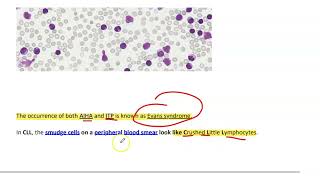 Chronic lymphocytic leukemiaCLL [upl. by Yeldar]