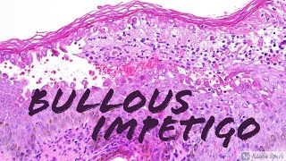 Bullous Impetigo vs Staphylococcal Scalded Skin SSSS 5Minute Pathology Pearls [upl. by Allets]