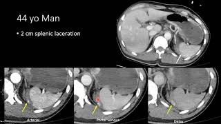 Blunt Abdominal Trauma Part 3 Splenic Injury short [upl. by Anilam664]