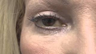 Management of PostBlepharoplasty Chemosis [upl. by Nirrok]