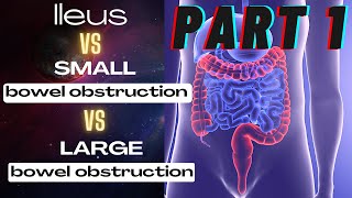 GENERAL SURGERY Small bowel obstruction vs large bowel obstruction vs Ileus [upl. by Danete693]