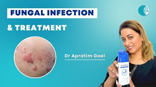 Get relief from excess sweat and itch Use Abzorb Dusting Powder Daily  Dr Apratim Goel [upl. by Oderfodog]