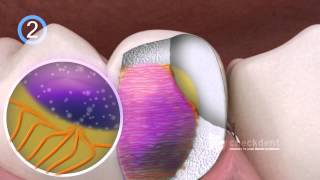 Dental Bonding of Ceramic Inlays [upl. by Aicnorev]