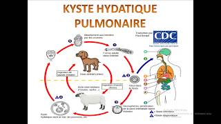 KYSTE HYDATIQUE PULMONAIRE [upl. by Nonnahsed450]