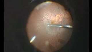 Vitrectomy for dropped lens fragments [upl. by Fugazy523]