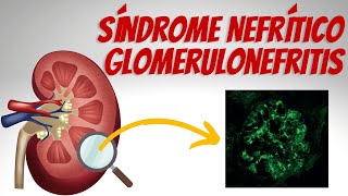 Síndrome Nefrítico  Glomerulonefritis Explicados Claramente [upl. by Llywellyn]