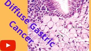 Diffuse Gastric CancerSignet ring cell Cancer Microscopy HistopathologyShorts [upl. by Mccahill]