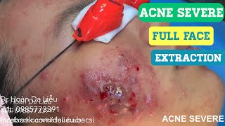 Nặn mụn nhọt áp xe đầy mủ vùng mặtSqueeze super big big pimples whitehead blackhead anti acnes [upl. by Eydnarb]