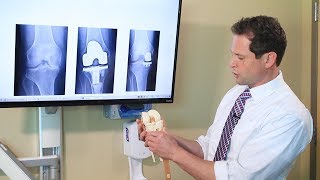 Types of Knee Replacement Surgery  Dr Mohit Gupta  Orthopedic Surgeon [upl. by Nabroc]