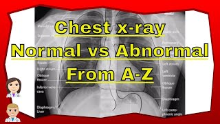 ☑️ Chest Xray normal vs abnormal Everything You Need To Know [upl. by Weight899]