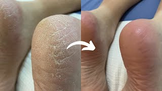 Satisfying Dead Skin Removal From Dry Feet Using 3 Different Tools  Foot Massage No Talking [upl. by Anitak]