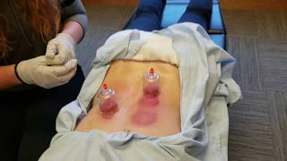 Cupping Therapy Benefits for Low Back Pain  Pro Chiropractic Bozeman [upl. by Berta]