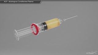 ACP  Autologous Conditioned Plasma [upl. by Marala197]