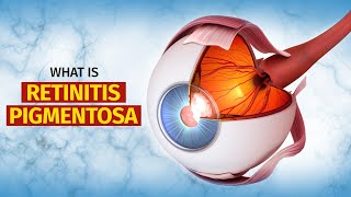 What is Retinitis Pigmentosa RP  Symptoms Treatment and More [upl. by Garling]