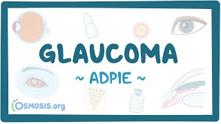 Glaucoma Nursing Process [upl. by Bucher]