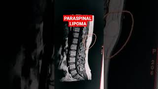 Paraspinal Lipoma mri shorts mriradiographer MRI Dorso Lumbar Spine  T1W Sequence [upl. by Mariya216]