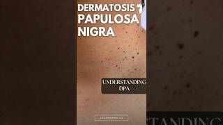 Understanding Dermatosis Papulosa Nigra [upl. by Tnilk]