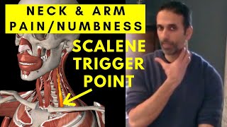 NECK amp ARM pain Relief Scalene Muscle Trigger Points [upl. by Razec]