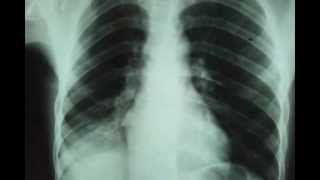 Baghdad medical cityclinical examination videoby drHamza Alsabahchest xray and ct scan chest [upl. by Sivam264]