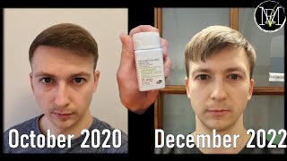 Oral Minoxidil for Hair Loss My Personal Journey [upl. by Odranar503]