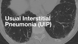 Usual Interstitial Pneumonia UIP [upl. by Felicdad]