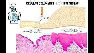 Adaptações celulares  HipertrofiaAtrofiaHiperplasia e Metaplasia [upl. by Atnim]