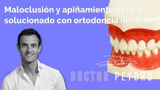 Maloclusión y apiñamiento dental solucionado con ortodoncia invisible [upl. by Amr]