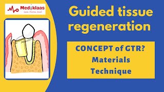 Guided Tissue Regeneration  Concept of GTR I Periodontal Regeneration l Mediklaas [upl. by Kelsi186]